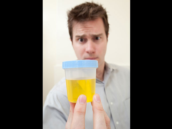 Màu sắc nước tiểu thay đổi cũng là một vấn đề mà bạn phải lưu tâm. Nước tiểu có màu đen, nâu đục là một trong những dấu hiệu cảnh báo gan đang bị tổn thương. Tình trạng đổi màu nước tiểu xảy ra là do mức bilirubin được sản xuất quá nhiều trong cơ thể nhưng gan không lọc được và nó buộc phải thải ra ngoài qua thận.