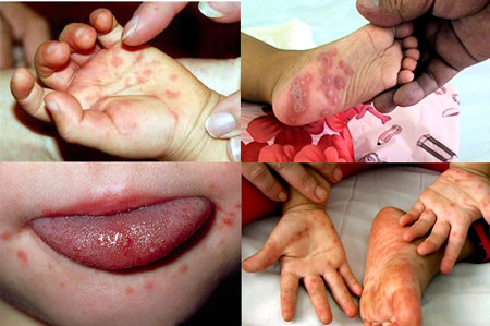 Ban đầu khi mới bị tay chân miệng trẻ thường sốt nhẹ, đau họng, đau miệng, chảy nước miếng và biếng ăn. Vì những dấu hiệu không rõ ràng nên bệnh thường khó phát hiện, hoặc thường được phát hiện muộn. Ảnh: Benhvirus.