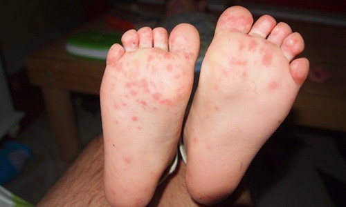 Rất nhiều cha mẹ sai lầm cho rằng, bệnh chân tay miệng tuy dễ lây nhưng lành tính và dễ khỏi nên thường chủ quan. Ảnh: Giadinhvietnam.