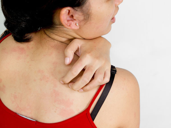 Thường xuyên bị ngứa và nổi mẩn khắp trên da trong một số trường hợp cũng là dấu hiệu cảnh báo sớm bệnh ung thư. Khi bạn bị ung thư nhất là ung thư da hệ thống miễn dịch của bạn sẽ bắt đầu phải chiến đấu với những tác nhân gây bệnh, việc này sẽ làm tăng lưu lượng máu tới vùng da bị bệnh khiến da bạn nhạy cảm hơn và dễ ngứa ngáy hơn.