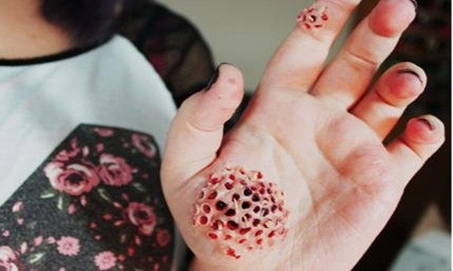 Bệnh nhiễm trùng giòi maggot: Đây được xem là căn bệnh khủng khiếp ghê rợn nhất trong tất cả các chứng bệnh kỳ quái.