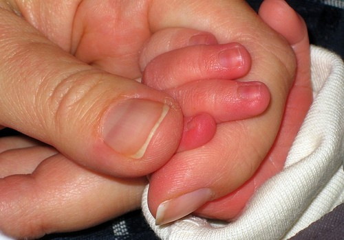 Bệnh chân tay miệng cũng là căn bệnh dịch dễ lây lan trong mùa hè. Bệnh này có thể tự khỏi tuy nhiên nó cũng có những biến chứng vô cùng nguy hiểm. Trẻ bị biến chứng khi mắc chân tay miệng thường diễn biến xấu rất nhanh và có nguy cơ tử vong cao. Ảnh: Kiến thức Việt.
