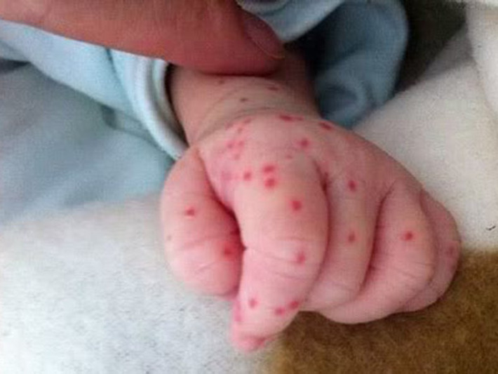Sốt xuất huyết cũng dễ bùng phát trong mùa hè vì đây là mùa muỗi sinh sôi nhanh và truyền bệnh mạnh hơn. Sốt xuất huyết không có vắc xin phòng bệnh vì thế bạn phải thường xuyên vệ sinh nhà cửa, diệt muỗi, ngủ màn để phòng muỗi đốt. Ảnh: Kiến Thức.