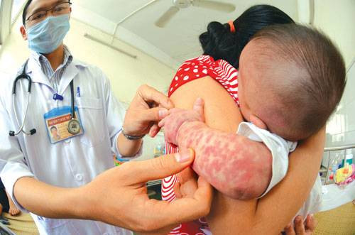 Mùa hè cũng là mùa của bệnh sởi và nguy cơ lây lan của bệnh sẽ nhanh và dễ dàng hơn. Bạn nên cho con em mình tiêm vắc xin phòng sởi để phòng bệnh hoặc giảm nguy cơ biến chứng có thể gặp phải. Ảnh: Yêu trẻ.
