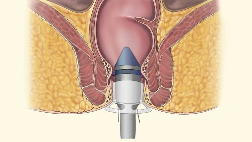 Nhẹ hơn là cảm giác đau đớn sau khi phẫu thuật. Bạn thường mất rất nhiều thời gian để kiêng khem và phục hồi sức khỏe sau cắt trĩ. Vì nếu không giữ gìn vệ sinh ăn uống khiến cơ thể bị táo bón sẽ dẫn tới nguy cơ tái phát bệnh trĩ.
