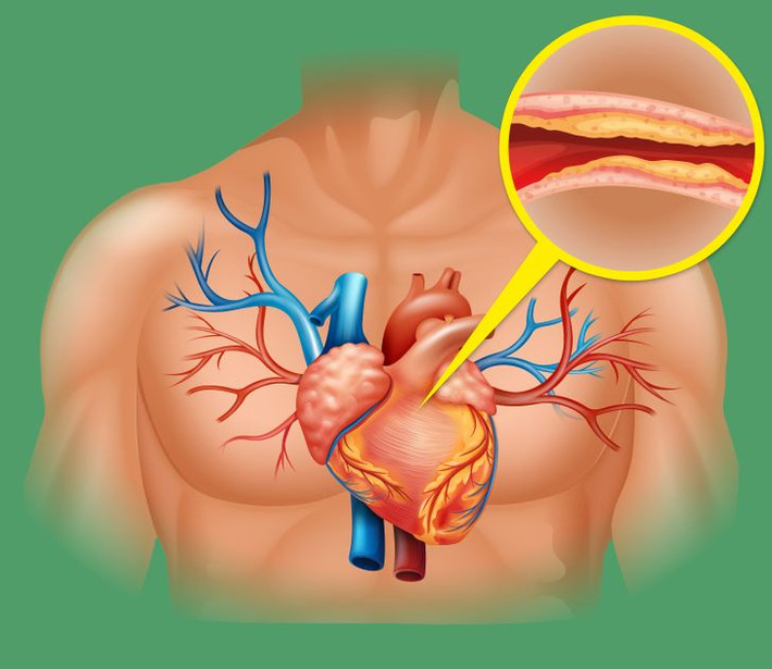 Giảm cholesterol, bảo vệ tim: Với đặc tính chống viêm cao, ăn hành tây làm giảm lượng cholesterol xấu trong cơ thể bạn. Nhờ đó, thói quen ăn hành tây hàng ngày cũng giúp ngăn ngừa nguy cơ mắc các bệnh về tim mạch.