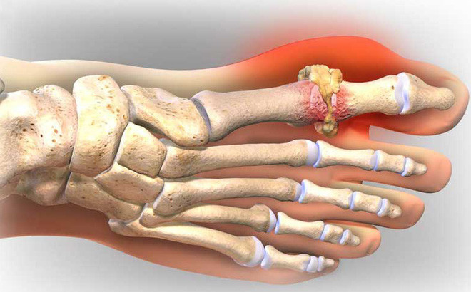 Bệnh gout do nhiều nguyên nhân gây ra như tăng bẩm sinh: Do ngay từ nhỏ, cơ thể người bệnh bị thiếu men HGPT do đó lượng acid uric không ổn định sẵn. Đây là trường hợp rất hiếm gặp nhưng khi gặp thì bệnh lại rất nặng, rất khó phát hiện và điều trị.