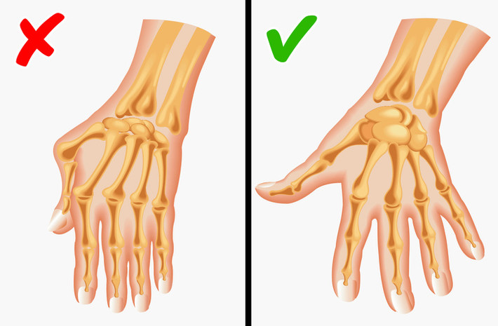 Viêm khớp dạng thấp: Dù chưa tìm ra nguyên nhân cụ thể gây viêm khớp dạng thấp nhưng các nhà khoa học cho rằng, căn bệnh này có liên quan đến gen di truyền. Để ngừa căn bệnh này, chúng ta cần bỏ thuốc lá, không ăn quá nhiều thịt đỏ, chăm sóc răng miệng và cung cấp đủ vitamin C cho cơ thể.