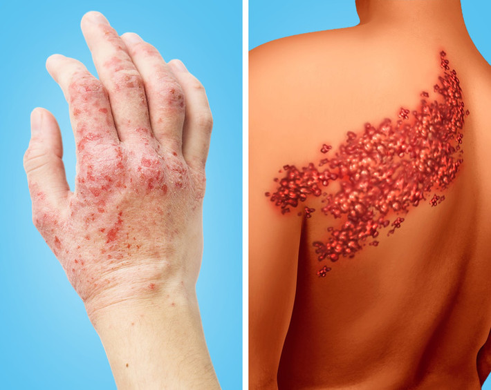 Phát ban da hoặc những đốm bất thường: Một nghiên cứu của Mỹ cho thấy người mắc bệnh chàm và bệnh zona có nguy cơ cao mắc bệnh tim. Những người bị bệnh chàm da có 48% khả năng bị huyết áp cao và 29% khả năng bị cholesterol cao. Ảnh: BS.