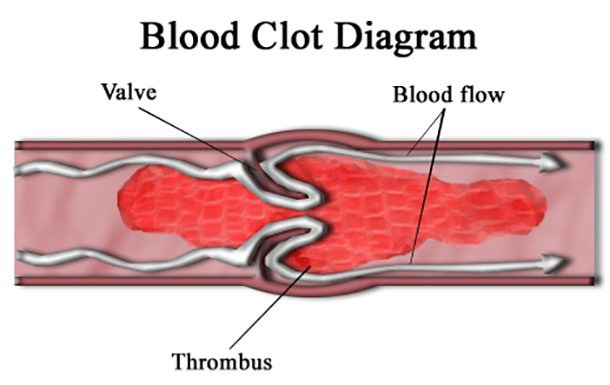 Nhóm máu của bạn xác định nguy cơ mắc bệnh tim. Trung bình, nhóm máu không phải O có nguy cơ bị cục máu đông cao hơn từ 60-80%. Họ cũng có nguy cơ mắc bệnh tim mạch cao hơn.
