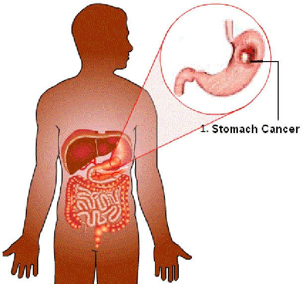 Giáo sư Gustaf Edgren của Viện Karolinska ở Thụy Điển nói rằng những người nhóm máu A có nguy cơ mắc ung thư dạ dày cao.