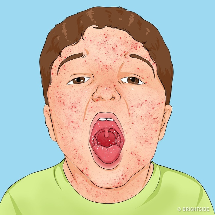 Bệnh sởi và bệnh cúm rất khó phân biệt với nhau ở giai đoạn đầu. Tuy nhiên, khi một đứa trẻ bị sởi, có những thay đổi nhất định như xuất hiện những đốm trắng bên trong má.