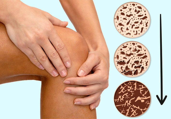 Loãng xương xảy ra do sự giảm nồng độ estrogen trong cơ thể. Bạn có thể mất đến 20% mật độ xương trong 5 năm đầu tiên của thời kỳ mãn kinh. Điều này có thể làm tăng nguy cơ loãng xương.
