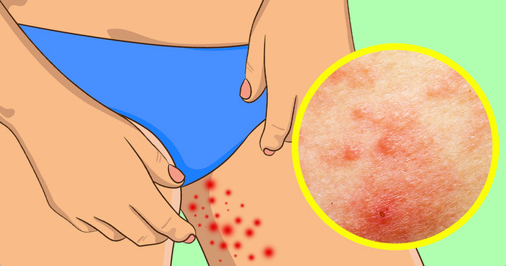 Nếu bị kích ứng da sau một ngày mặc quần short hoặc váy ngắn đi bộ trong ngày nóng, bạn hãy thường xuyên dưỡng ẩm cho làn da. Sử dụng các loại kem có chứa các vitamin C và E tự nhiên hoặc chiết xuất từ dưa chuột.