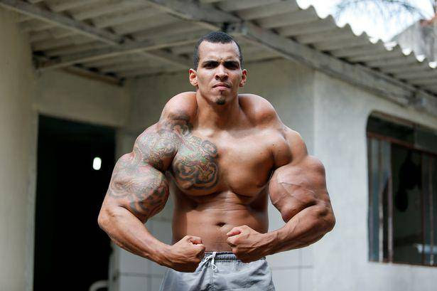 Một người đàn ông ở Brazil không ngại nguy hiểm, chấp nhận tiêm chất độc synthol vào người để tăng cơ bắp, hòng giống như người khổng lồ xanh The Hulk. (Ảnh: Mirror)