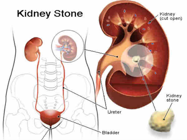 Thận được tạo thành từ hàng triệu tế bào nhỏ xíu được gọi là nephrons. Chúng là những chất lọc máu không tinh khiết xâm nhập vào thận. Sau đó máu sẽ được làm sạch và trở lại cơ thể để lưu thông. Do đó, thận là cơ quan rất quan trọng đối với hoạt động của cơ thể. Nếu bạn đang bị sỏi thận, hãy tham khảo một số biện pháp khắc phục tự nhiên để loại bỏ sỏi thận thay vì phẫu thuật. Ảnh: Boldsky.