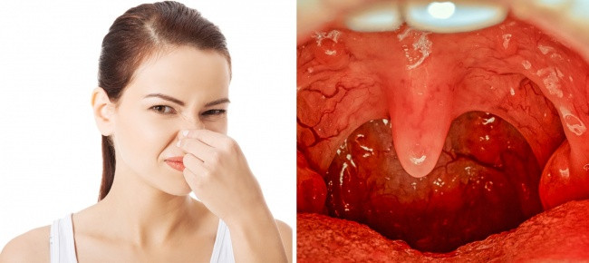 Kiểm tra sỏi amiđan: Nếu bạn không biết, sỏi amiđan là một hỗn hợp của các mảnh vụn và vi khuẩn nằm ở phía sau cổ họng. Chúng trông giống như đốm trắng hoặc da gà và mùi thực sự khó chịu. Để ngăn ngừa chúng xảy ra, chỉ cần đảm bảo bạn tuân theo một quy trình vệ sinh phù hợp và thường xuyên đến nha sĩ thăm khám. Ảnh: BS.