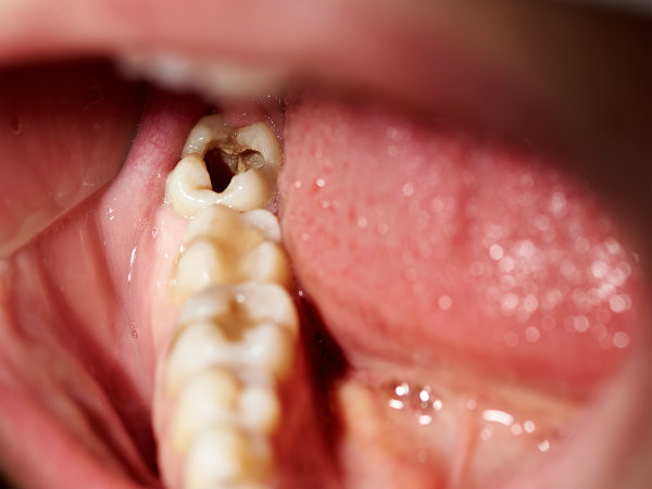 Ăn nhiều đường cũng có thể khiến bạn bị sâu răng. Vì vậy, nếu bạn nhận thấy những mảng ố đen trên các kẽ răng và cảm thấy đau khi bạn cắn một cái gì đó thì chắc chắn bạn đang ăn quá nhiều đường.