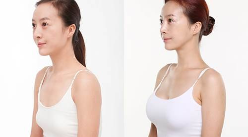 Cũng giống như kem thoa, nhiều loại thực phẩm chức năng cũng được rao bán có chức năng “tăng kích cỡ vòng ngực” được quảng bá xuất xứ từ: Mỹ, Australia, Nhật Bản theo con đường xách tay. Không chỉ vậy, các sản phẩm này còn được quảng cáo “tăng hưng phấn tình dục, giúp da mịn đẹp, điều hòa kinh nguyệt…”. Giá cả các loại thực phẩm chức năng này dao động từ vài trăm nghìn đến hơn triệu đồng.
