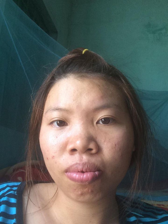 Sau 14 ngày trải qua quá trình "dao kéo", Kim Phượng cho biết: "Các cuộc phẫu thuật gần như đã hoàn tất. Mình cảm thấy sức khỏe vẫn rất ổn, so với những cảnh báo trước đây thì mình thấy phẫu thuật cũng không đau đớn như tưởng tượng".