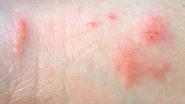 Mụn giộp sinh dục (còn gọi là HSV) do virus, gây đau đớn hoặc bỏng rộp ở cơ quan sinh dục, mông, đùi hay miệng. Thường có hai dạng: HSV-1, gây đau, thường bắt đầu từ miệng nhưng có thể lây lan đến “vùng kín”; HSV-2, thường gây nhiễm trùng cơ quan sinh dục.