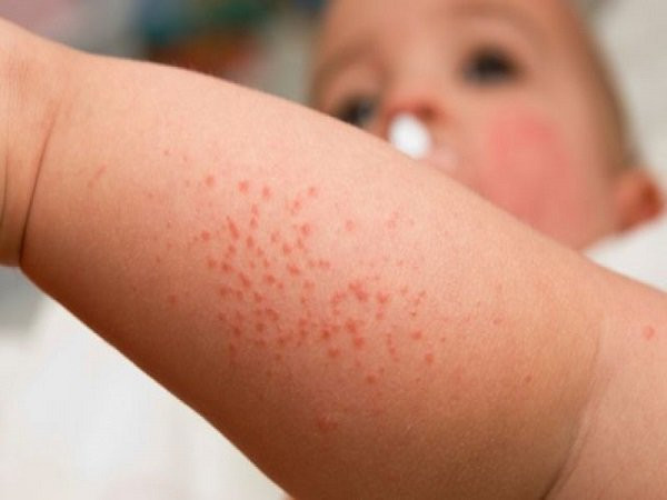 Sốt xuất huyết: Bệnh do muỗi truyền, có thể xuất hiện quanh năm, nhưng phát triển mạnh vào mùa cuối hè, đầu thu, hoặc khi không khí ẩm thấp. Bệnh hay gặp ở bé, đặc biệt là dưới 10 tuổi. Dấu hiệu: Bé sốt cao đột ngột và liên tục (39-40°C) trong vòng 2-4 ngày, có thể xuất hiện dấu xuất huyết dưới da mọc thành từng đám rải rác, có thể xuất huyết ở niêm mạc miệng, đi tiêu ra máu…