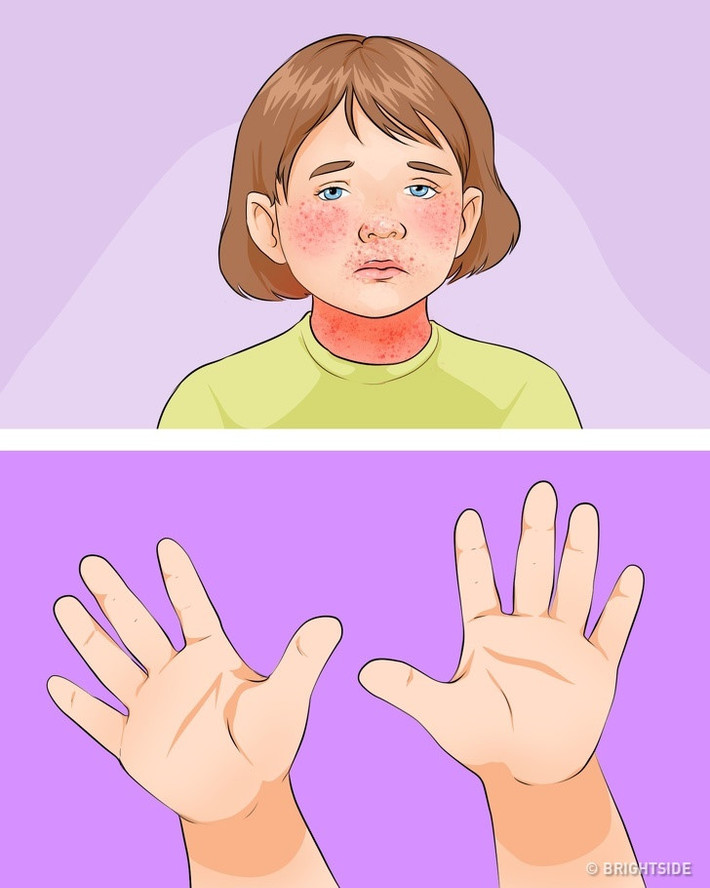Rubella: Đây là căn bệnh truyền nhiễm gây ra bởi một loại virus gây hại cho hệ thống miễn dịch, tất cả các cơ quan và hệ thống nội tạng. Một triệu chứng quan trọng của rubella là phát ban xuất hiện vào ngày thứ 3 sau khi mắc bệnh. Ở giai đoạn đầu, phát ban bắt đầu xung quanh tai, phần phía trước của cổ và má nhưng không bao giờ xuất hiện trên lòng bàn tay hoặc bàn chân. Kiểm tra phát ban, máu và nước tiểu của trẻ có thể giúp chẩn đoán bệnh.