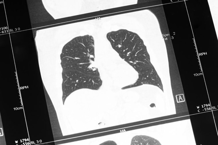 Bệnh phổi tắc nghẽn mãn tính (COPD) là một bệnh mãn tính và tiến triển tại phổi khiến cho người bệnh cảm thấy khó thở. Theo WHO, hằng năm có khoảng 3,1 triệu ca tử vong do mắc COPD, tương ứng với 5,6% trong tổng số trường hợp tử vong trên toàn thế giới.