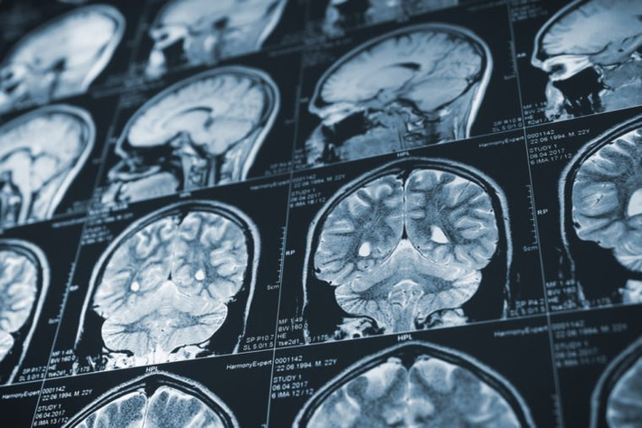 Bệnh Alzheimer và các chứng mất trí khác: Mặc dù căn bệnh tiến triển này không phải lúc nào cũng là nguyên nhân trực tiếp gây tử vong nhưng bệnh Alzheimer cũng góp phần vào các yếu tố khác làm giảm tuổi thọ của con người hoặc gây biến chứng chết người.