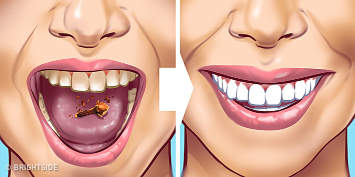 Đinh hương: Nghiền đinh hương, thêm một ít dầu ôliu và thoa hỗn hợp lên các khu vực có cao răng hoặc nhai trực tiếp đinh hương.