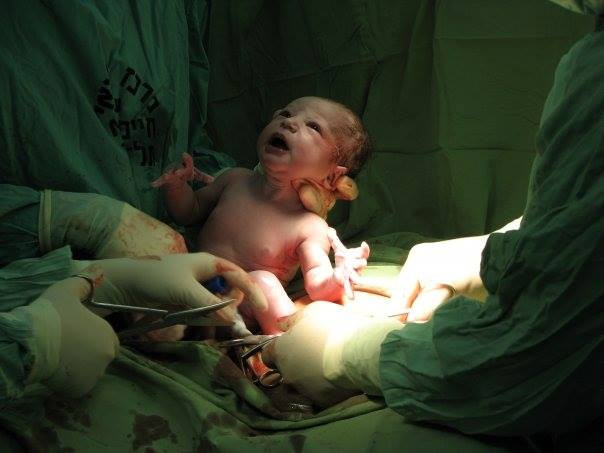 Kết thúc ca mổ đẻ bác sĩ sẽ khâu lại vết rạch trên bụng sản phụ. Vết rạch này thường để lại sẹo khá lớn.