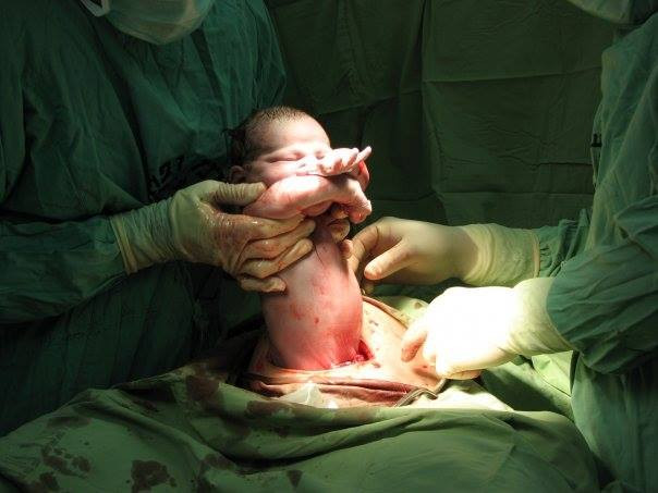 Khi thuốc gây tê có hiệu quả, bác sĩ sẽ rạch một đường ở phần bụng dưới. Nếu mẹ đủ tỉnh táo thì sẽ cảm nhận dược vết dao rạch nhưng không hề thấy đau đớn. Vết rạch này sẽ là được để bác sĩ đưa em bé ra ngoài. Hình ảnh toàn thân em bé được đưa ra ngoài.