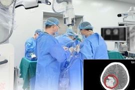 Cứu sản phụ mang thai tuần 19 đột quỵ do tiền sản giật