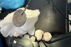 Trẻ 11 tuổi đau nghẹn vùng cổ, bác sĩ phát hiện đồng xu 3 cm nằm ở thực quản