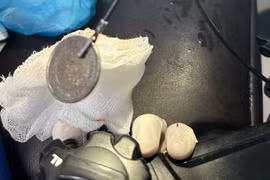 Trẻ 11 tuổi đau nghẹn vùng cổ, bác sĩ phát hiện đồng xu 3 cm nằm ở thực quản