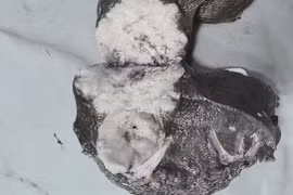 Phẫu thuật thành công cho bệnh nhân ung thư gan ở Đà Nẵng