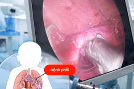 Phẫu thuật điều trị dị dạng phổi bẩm sinh hiếm gặp ở trẻ em