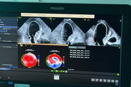 Siêu âm tim gắng sức bằng Dobutamine, phát hiện sớm thiếu máu cơ tim