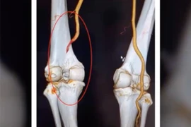 Người đàn ông Phú Thọ hồi sinh chân trái sau chấn thương đứt mạch máu khoeo