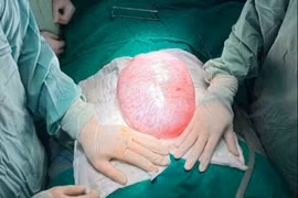 Lấy u buồng trứng nặng 4 kg ở bé gái tuổi dậy thì