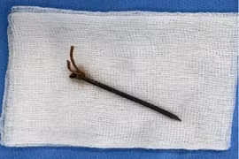 Kịp thời cứu sống người đàn ông bị vết thương khí quản do vật xuyên thấu