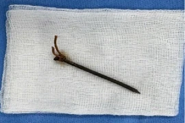 Kịp thời cứu sống người đàn ông bị vết thương khí quản do vật xuyên thấu