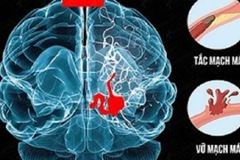 Địa chỉ vàng: Bệnh viện cấp cứu bệnh nhân đột quỵ tại Hà Nội