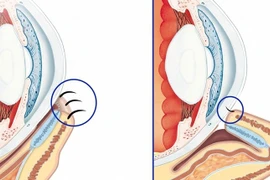 Lông mi mọc ngược chọc xước giác mạc