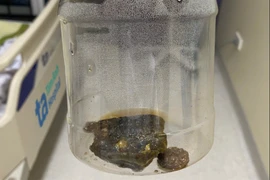 Đau bụng, nôn về đêm, cụ bà 95 tuổi bị tắc ruột do ăn cơm với trám