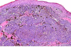 Tại sao cần xét nghiệm mô bệnh học sau khi cắt nốt ruồi?