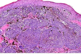 Tại sao cần xét nghiệm mô bệnh học sau khi cắt nốt ruồi?