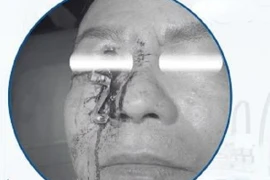 Loại bỏ dị vật kim loại lớn đâm xuyên vùng hốc mắt