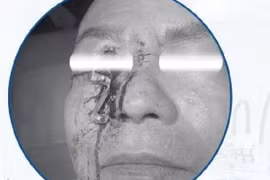 Loại bỏ dị vật kim loại lớn đâm xuyên vùng hốc mắt