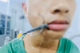 Bé trai gặp nguy hiểm khi bị lưỡi câu móc vào mặt tại Nghệ An